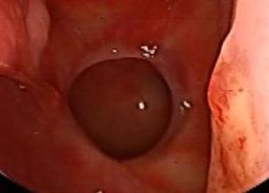 Left-sided sphenoidotomy site at 6 weeks postopera