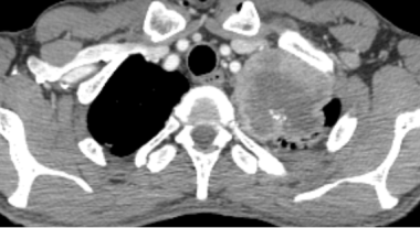 A 50-year-old male with Pancoast tumor. An axial C