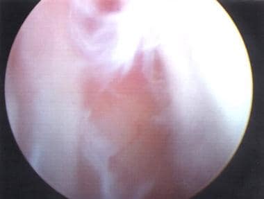 Grade IV scapholunate tear, as depicted from the m
