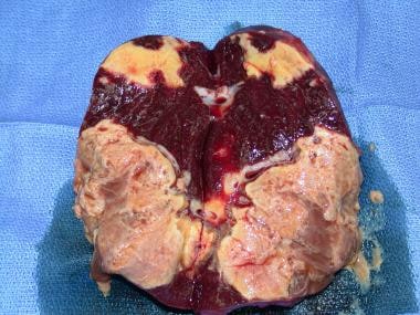 Resected spleen (same as in above image) with absc