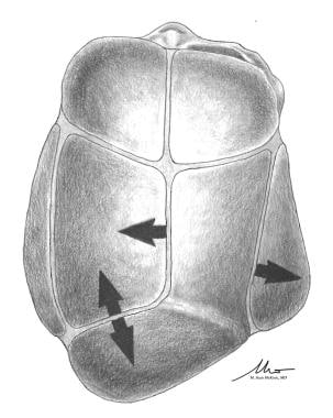Lambdoid craniosynostosis (posterior plagiocephaly