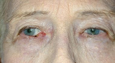 Basal cell carcinoma of the right lower lid. 