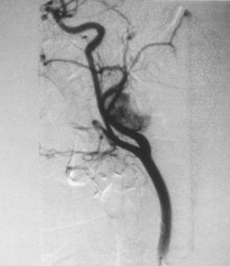 Angiogram of glomus vagale tumor. Because the vagu