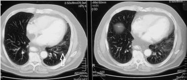 A case of micro-aspiration (2 of 3 images). CT of 
