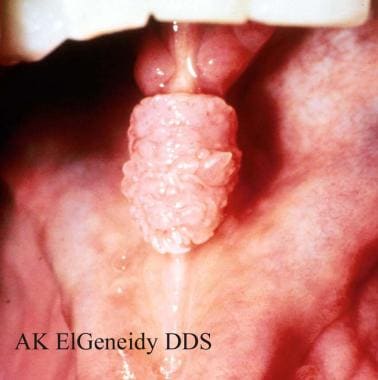 Human papillomavirus (HPV). Some patients with con