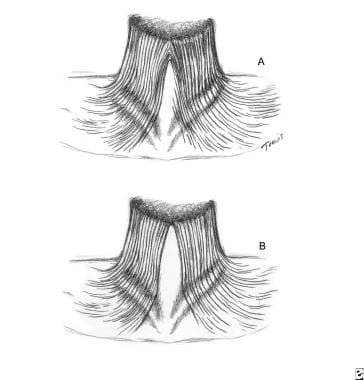 (A) The platysma muscle is joined together at the 