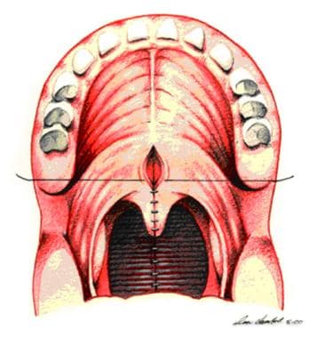 Oral side of soft palate is sealed to conceal phar