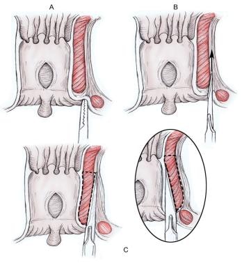 Lateral Anal Sphincterotomy 32