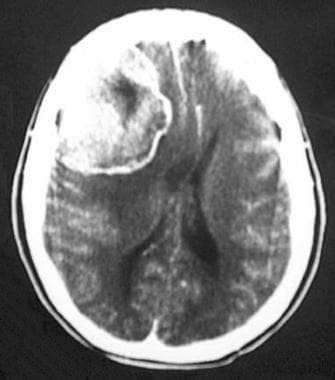 Computed tomography scan shows a malignant meningi
