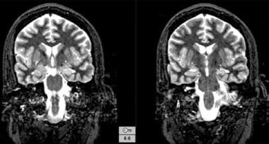 T2-weighted magnetic resonance images reveal the i