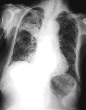 Posteroanterior chest radiograph in an 83-year-old