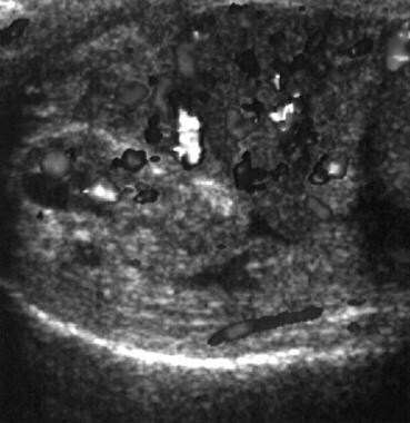 Color-flow ultrasonogram shows increased vasculari