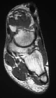 Coronal T1-weighted magnetic resonance image of th