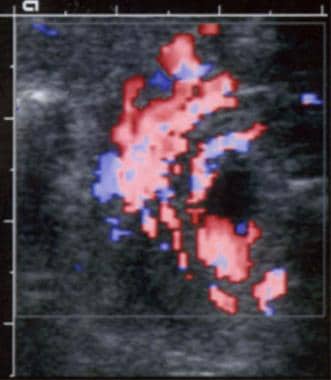 Color Doppler ultrasonographic scan shows malrotat