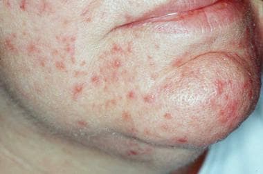 Topical steroid induced folliculitis