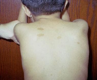 Café-au-lait spots in a 4-year-old boy. 