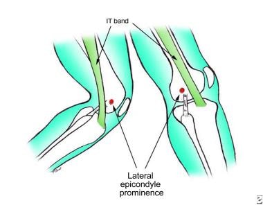 Illustration of the friction point at the lateral 