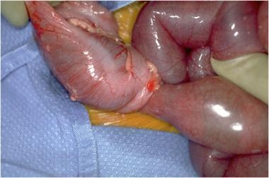 Pediatric Small Bowel Obstruction. This is a surgi