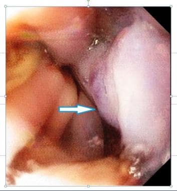 An endoscopic image of esophageal varices. Courtes