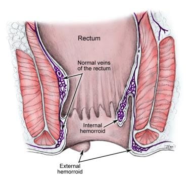 Hemorrhoids. Image reproduced from original with p