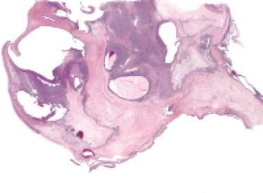 Granulosa cell tumor of ovary histopathology report