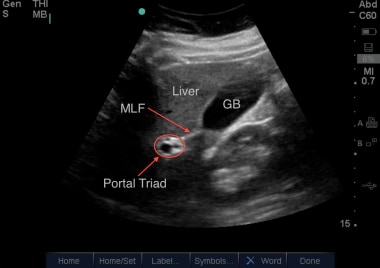 Here can be seen the gallbladder (GB) with the mai