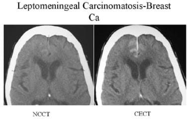 Precontrast- and postcontrast-enhanced CT of a pat