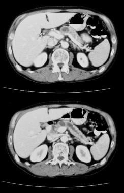  intraductal pankreatisk papillær mucinøs tumor (i