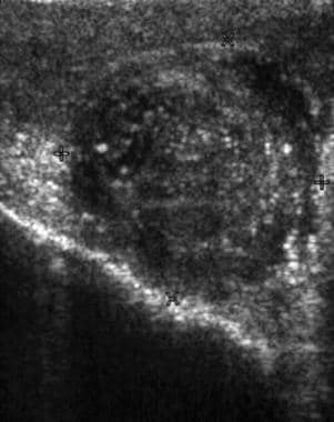 This ultrasonogram shows an enlarged epididymis wi