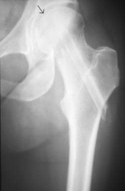 Anteroposterior view of the left hip in a patient 