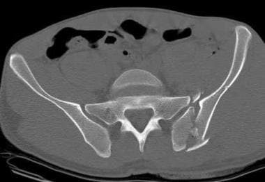 Vertical shear injury as seen on a pelvic CT scan.