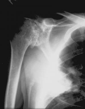 Radiograph of the shoulder of a 35-year-old man wi