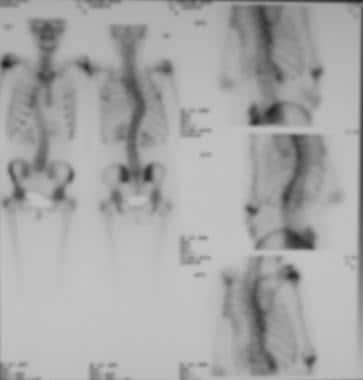 Bone scans in a patient with painful atypical scol