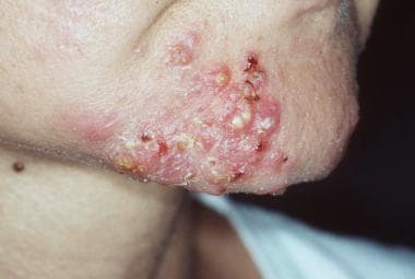 Steroid induced rosacea flushing