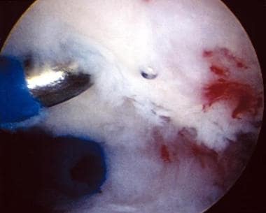 Electrothermal shrinkage performed in a patient wi