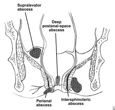 Illustration of major types of anorectal abscesses