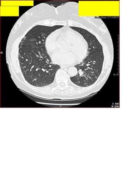 CT thorax of a 77-year-old woman who presented wit