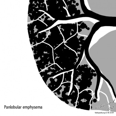 Emphysema. Panlobular emphysema. Courtesy of Dr Fr