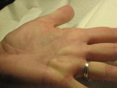 Dupuytren contracture. This photo demonstrates the