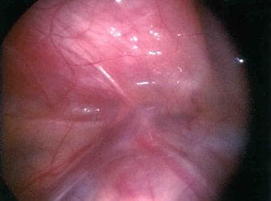 Laparoscopic view of enlarged lymphatics secondary