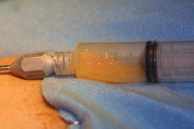 Gentle negative pressure is applied manually with