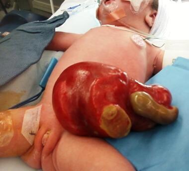 Pediatric omphalocele and gastroschisis (abdominal