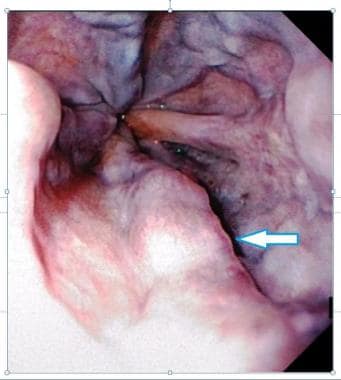 Endoscopic picture of esophageal varices. Courtesy