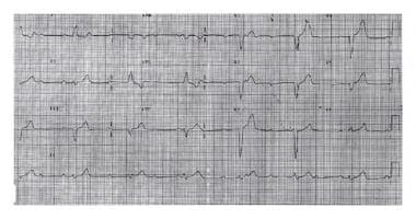 Electrocardiogram showing complete heart block. Th