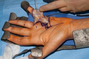 Dissection of spiral cord in the hand of a patient