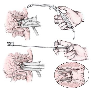 What is involved in the hemorrhoid banding procedure?