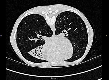 High-resolution chest CT showing marked chronic ch