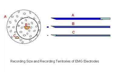 Electromyographic (EMG) evaluation of the motor un