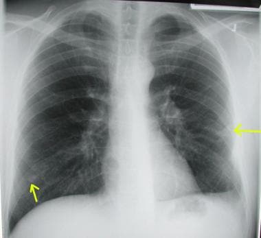 Chest radiograph shows bilateral pulmonary arterio
