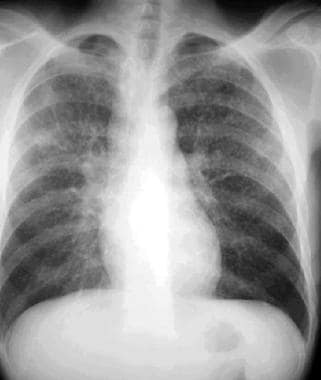 Posteroanterior chest radiograph in a 31-year-old 